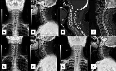 The clinical efficacy of anterior cervical discectomy and fusion with ROI-C device vs. plate-cage in managing traumatic central cord syndrome